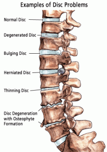 What's Worse—Bulging or Herniated Discs?