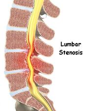 Stenosis diagram