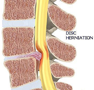 Close Up Herniated Disc Diagram