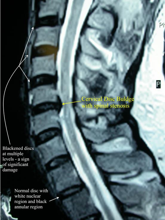 Spine Surgery Xray